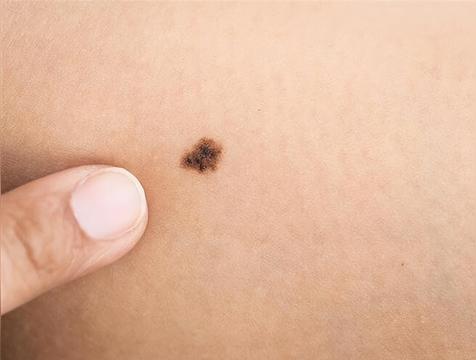 黑痣福气是什么意思