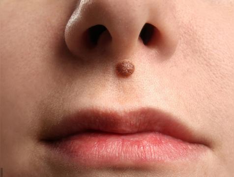 三角痣是绝命痣吗(三角痣的样子)