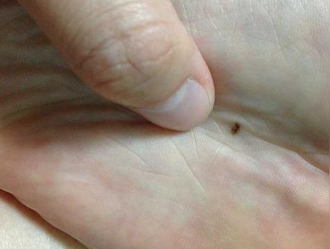 脚心有痣的女人代表什么意思