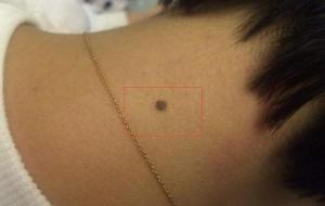 苦情痣长在哪里(苦情痣什么意思)