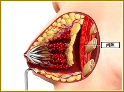 如何辨别是不是假胸（一眼分辨真假胸）