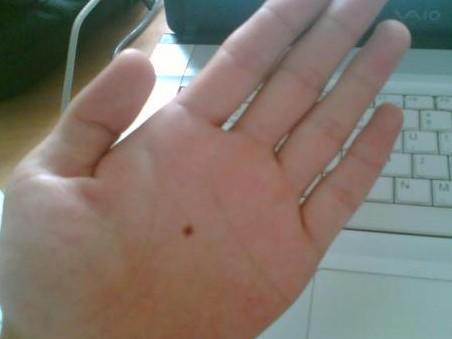 掌心痣的位置与命运(掌心痣代表意思)