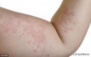 艾灸后可怕的排毒反应