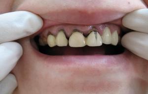 烤瓷牙的寿命是几年