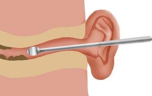 耳朵油腻怎么回事(耳朵油腻和狐臭关系)