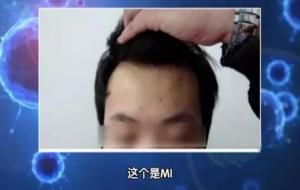 头发出油严重怎么解决