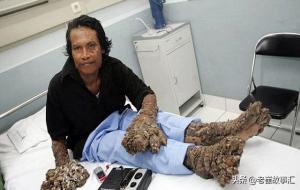 印尼树人图片（印尼树人是什么怪病）