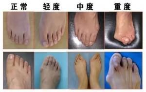 拇外翻是什么(治疗方法)