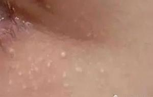 长期不洗脸小心粟丘疹